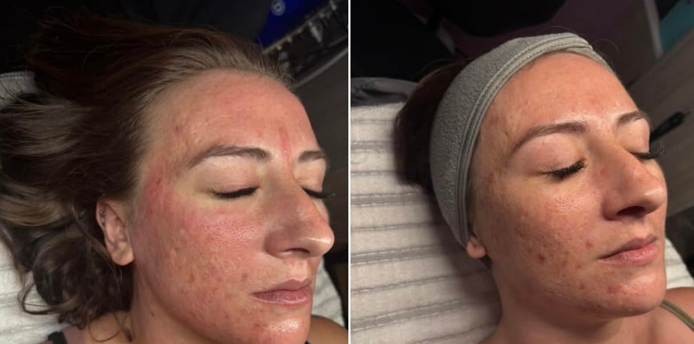 facial session 1 and 2 by Athena's Glow Salon