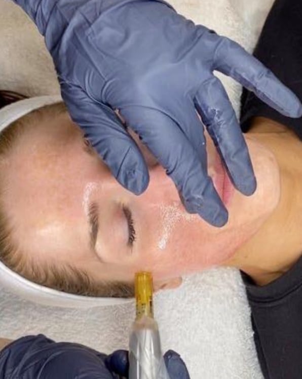 microneedling by Athena's Glow Salon
