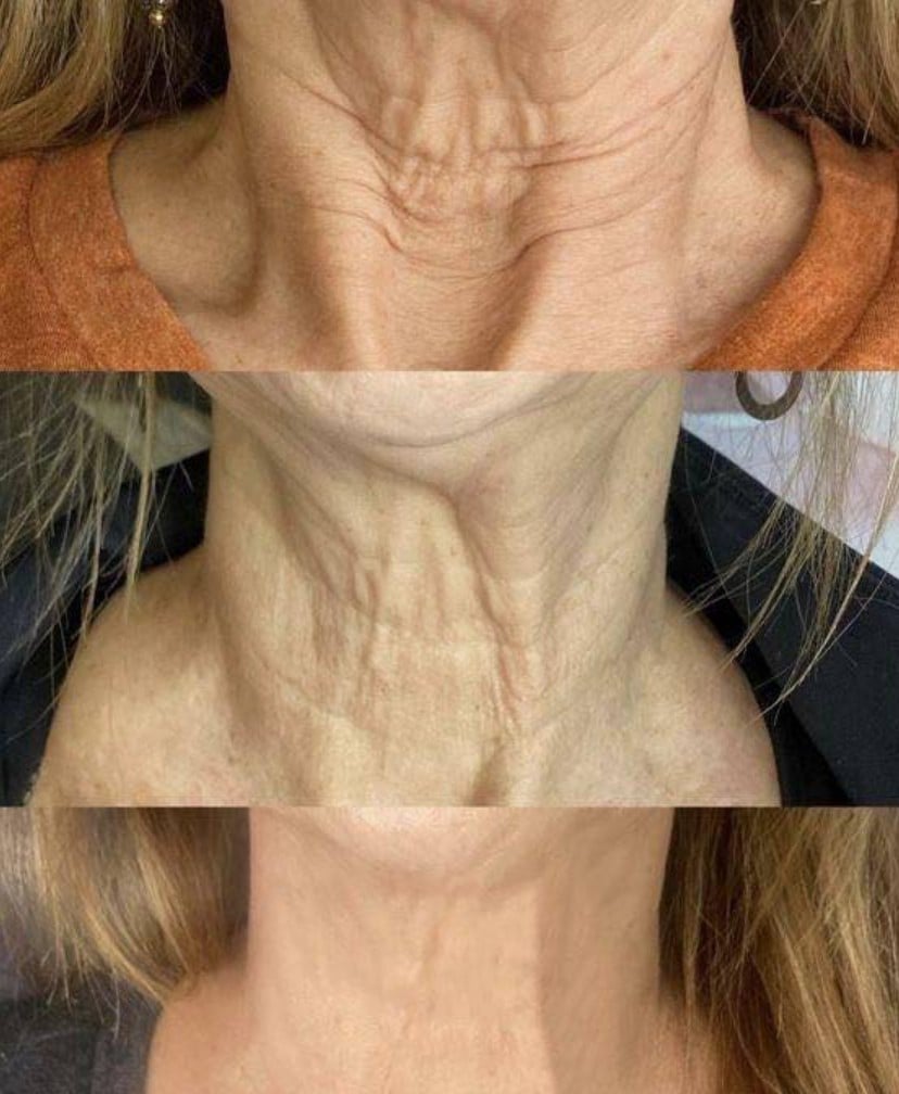 neck tightening regimen with glymed products by Athena's Glow Salon